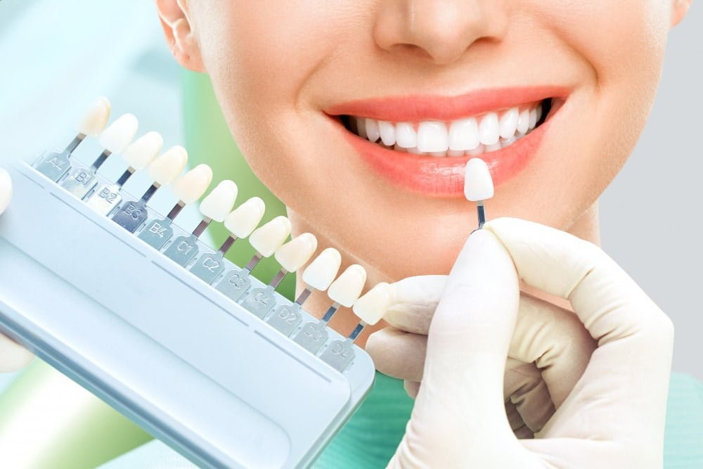 dental-veneers-in-turkey